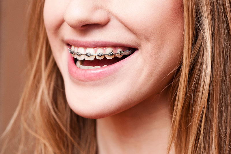 Orthodontics in Fort Worth