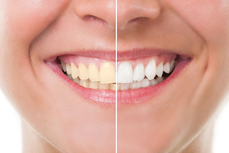 Teeth Whitening in Fort Worth